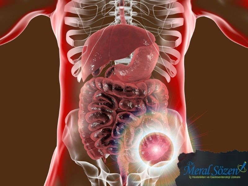 irritabl-bagirsak-sendromunun-sebepleri